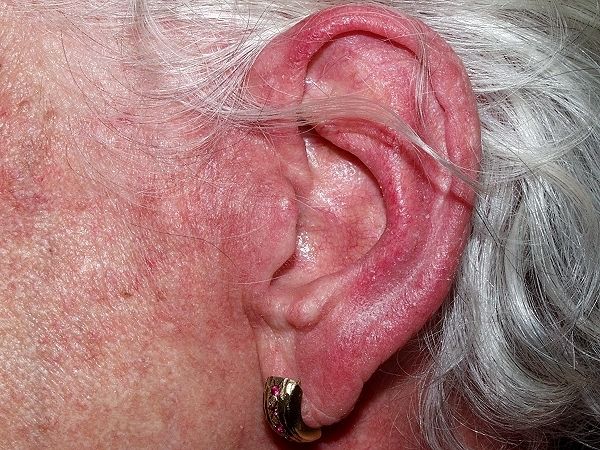 Eritema Auricular y Somnolencia Enrojecimiento recurrente que puede estar acompañado de somnolencia *Sx. Pick wick