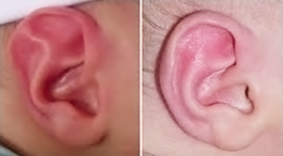 Tragus Ausente Ausencia de trago