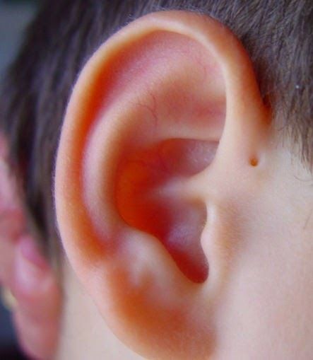Fosetas Preauriculares Hendidura pequeña en zona preauricular *S. BOR (branquio-oto-renal) *Asociación VACTERL