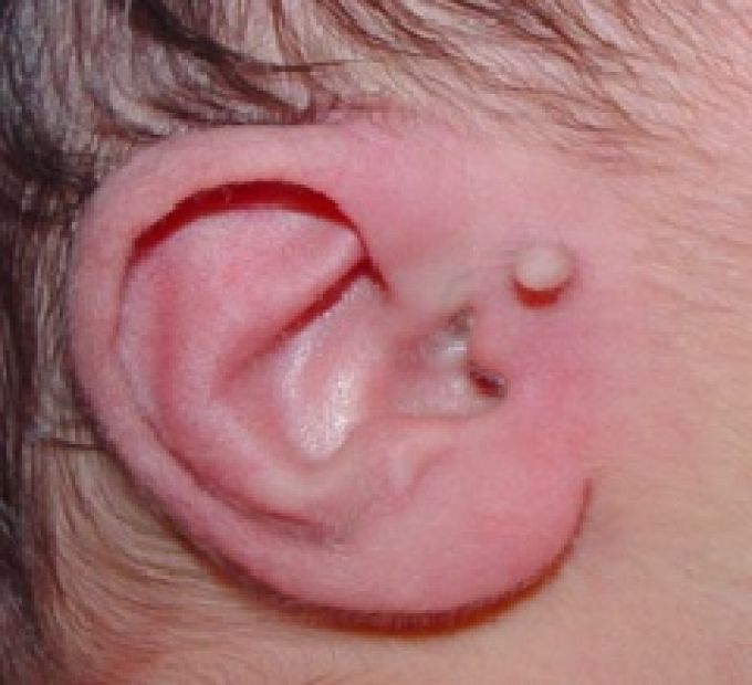 Apéndices Preauriculares Presencia de apéndices en la zona preauricular unilateral o bilateral *Asociación VACTERL