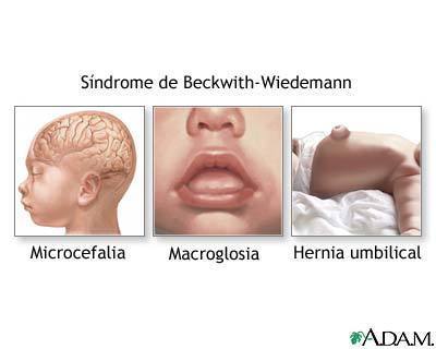 Sx. BECKWITH-WIEDEMANN Caracterizado por la tríada de onfalocele, macroglosia y gigantismo; predisposición al desarrollo tumoral