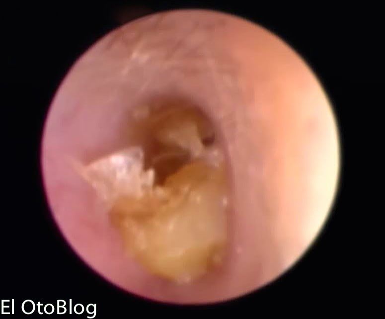 Tipo de Cerumen Seco: de color gris friable, frecuente en raza amarilla Húmedo: de color dorado a café, adherente frecuente en raza negra...