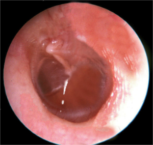 Suceptibilidad a la Otitis Media Predisposición genética a otitis media