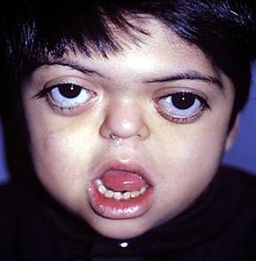 Sx. AARSKOG Estatura baja Hipertelorismo Escroto en forma de chal Braquidactilia Pico de viuda Filtrum ancho Nariz pequeña Hernia inguina...