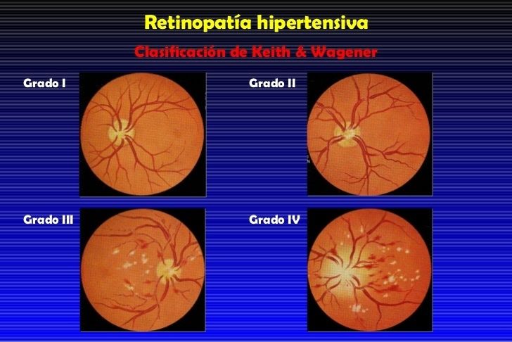 HIPERTENSIÓN ARTERIAL