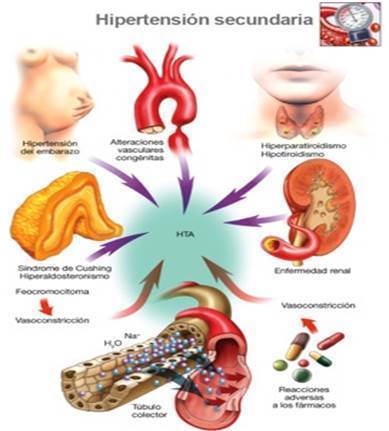 HIPERTENSIÓN ARTERIAL
