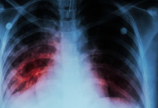 Tuberculosis •Gracias a el cambio climático y el calentamiento global la transmisión puede ser mayor •Se transmite por vía aérea -enferme...