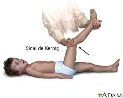 Sinal de Kernig