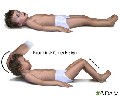 Sinal de brudzinski