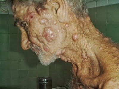 Manifestações Clínicas da forma lepromatosa da hanseníase