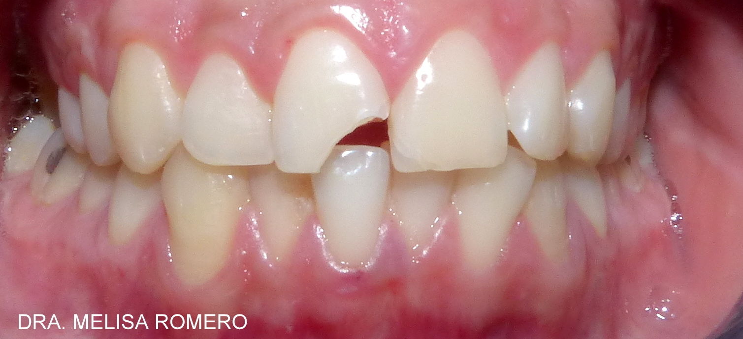 Fracturas de la corona dentaria