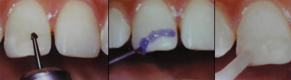 TRAUMATISMO DENTAL EN NIÑOS