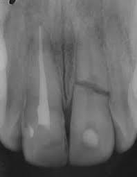 TRAUMATISMO DENTAL EN NIÑOS
