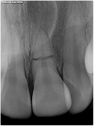 Fracturas de raíz