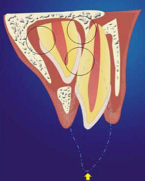Lesiones de los tejidos periodontales