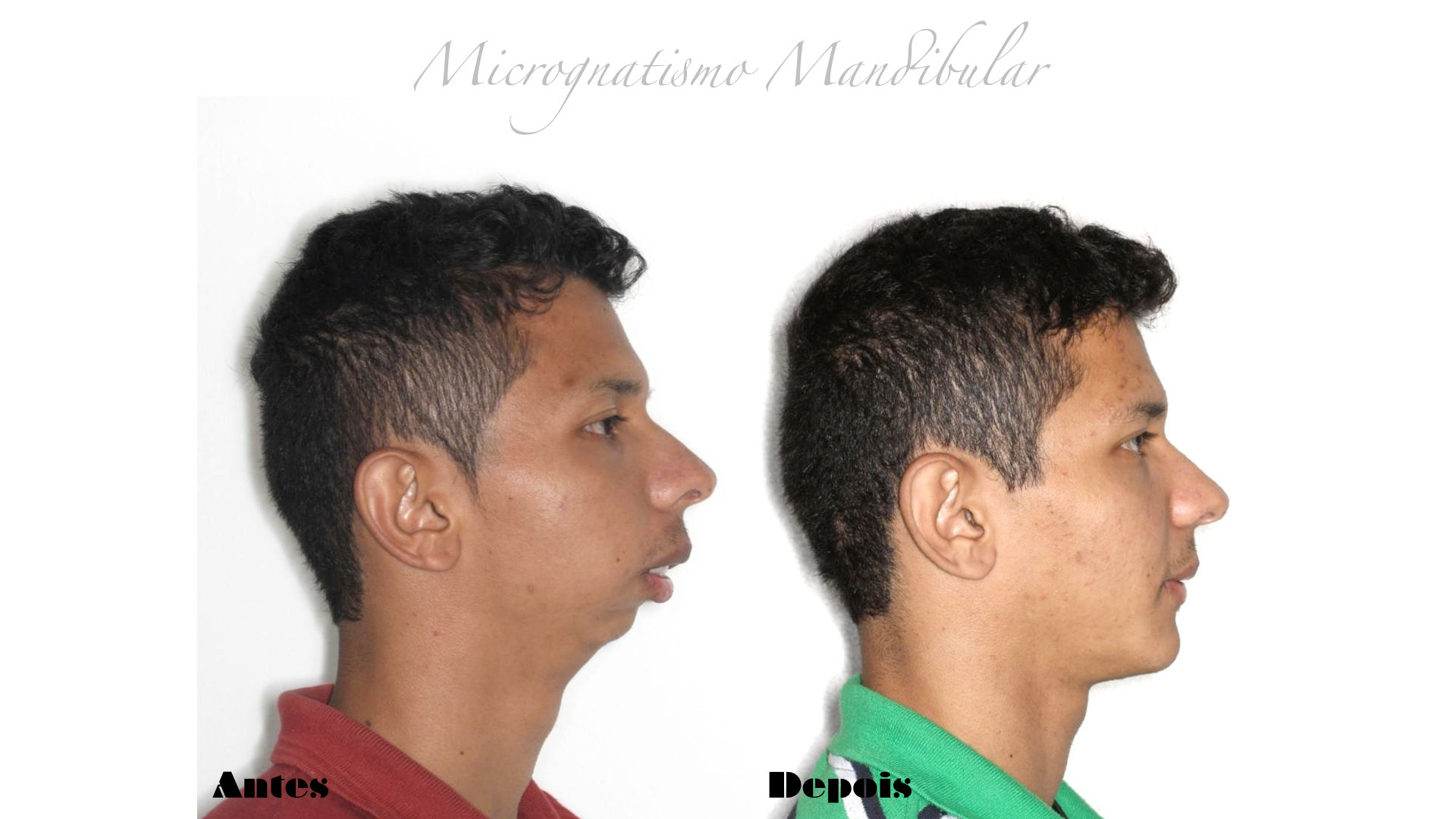 Medina, C. & Cols. (2010) plantean que la alimentación por medio del biberón y el uso del chupón se relacionan con una posición mandi...