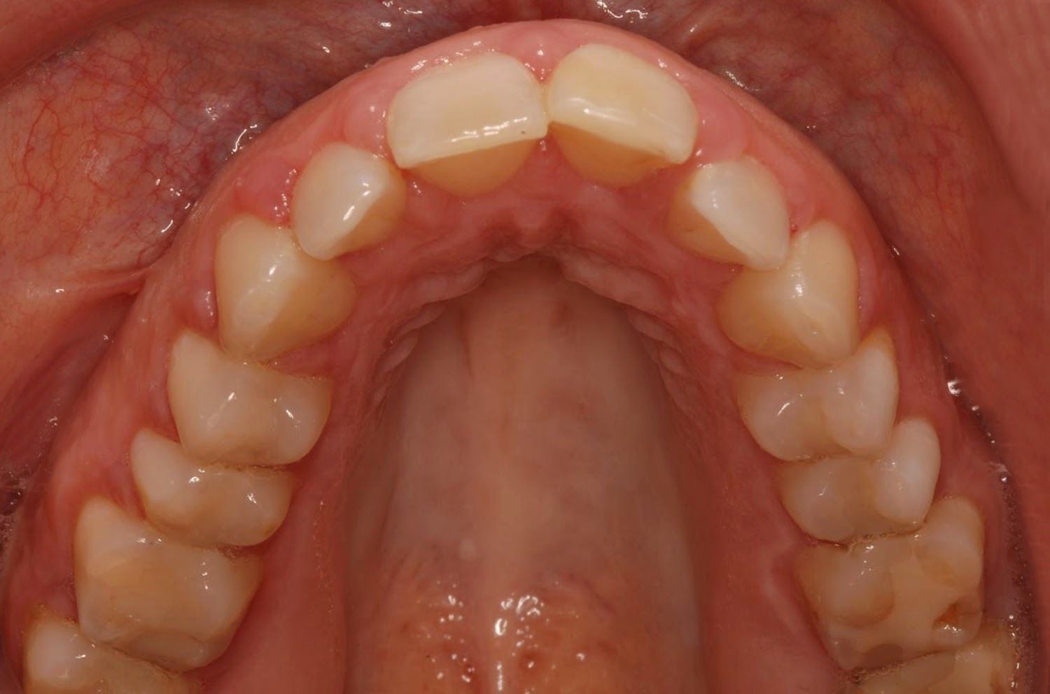 Blanco, L. & Cols. (2007) afirman que un periodo de lactancia menor de 6 meses se asocia con la presencia de paladar profundo.