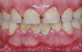 ENFERMEDAD PERIODONTAL