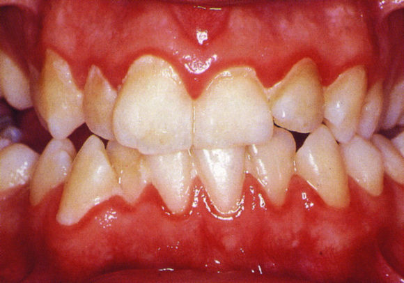 GINGIVITIS forma de enfermedad periodontal que involucra inflamación e infección que destruyen los tejidos de soporte de los dientes, inc...