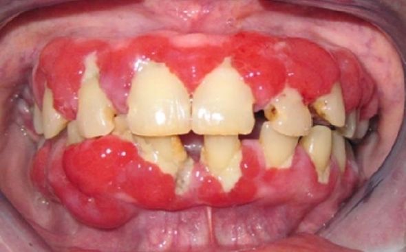 1) Periodontitis como manifestación de enfermedades sistémicas, 2) Enfermedad periodontal necrotizante 3) Periodontitis agresiva 4) Perio...