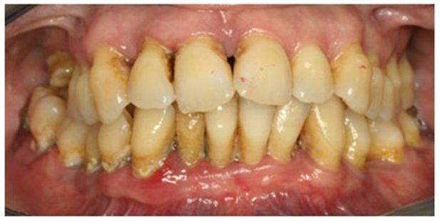 En la dentición mixta y ya en la adolescencia, el apiñamiento dental suele llevar a una mayor incidencia de gingivitis debido a la dificu...