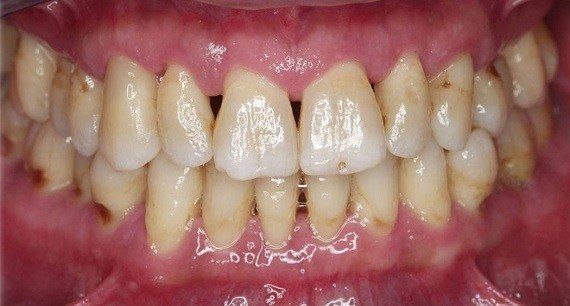 Los cambios hormonales relacionados con la pubertad pueden incidir en un mayor riesgo de padecer enfermedad periodontal.
