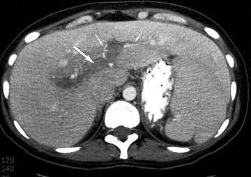 Uso de alcohol y dolor abdominal en un hombre de 49 años