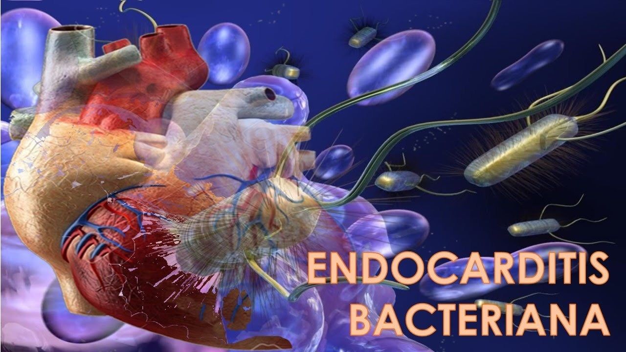 ENDOCARDITIS BACTERIANA.