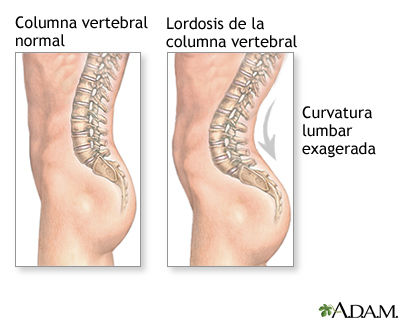 Lesiones comunes de espalda en los niños