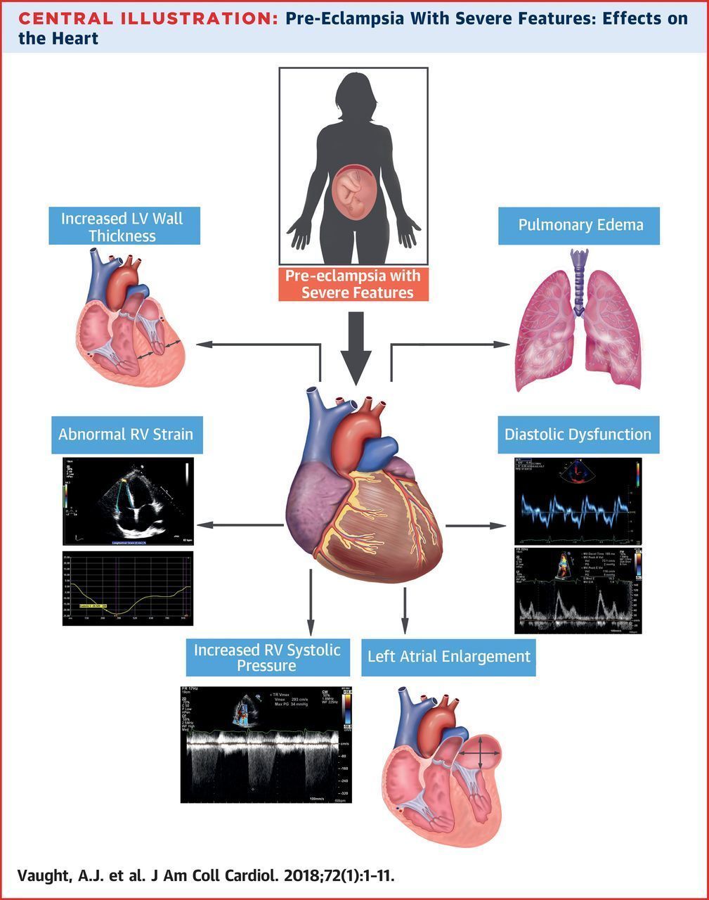 ECLAMPSIA