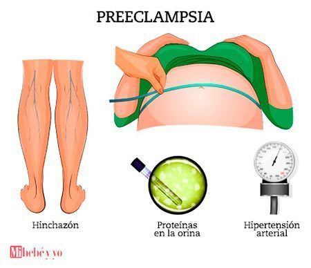 PREECLAMPSIA