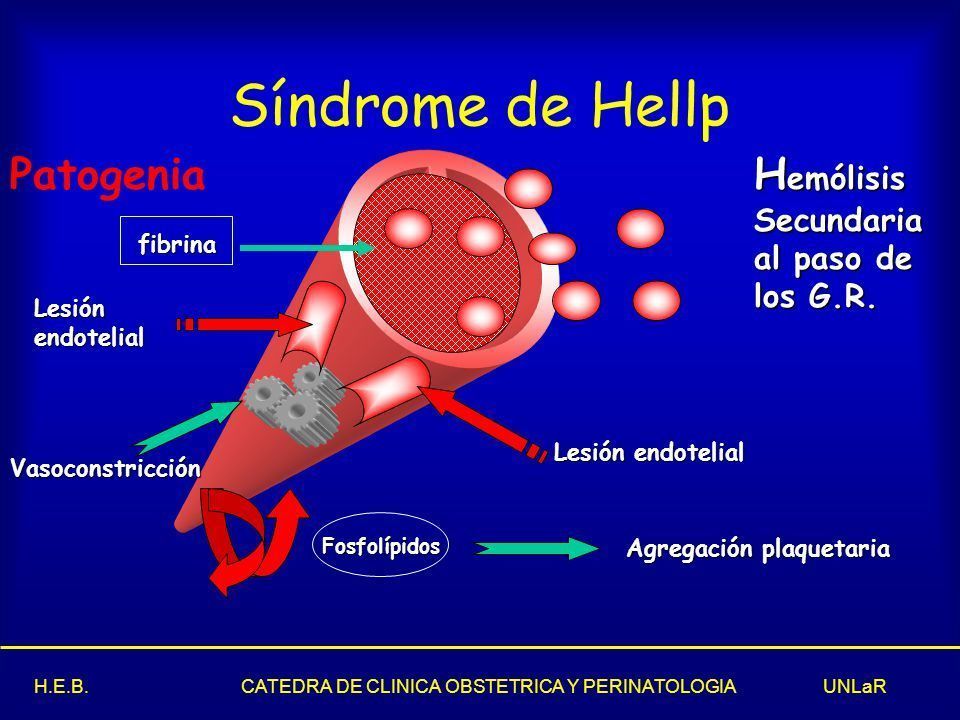 SINDROME DE HELLP