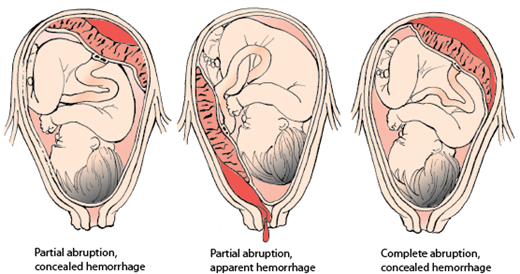 Desprendimiento prematuro de placenta normoinserta