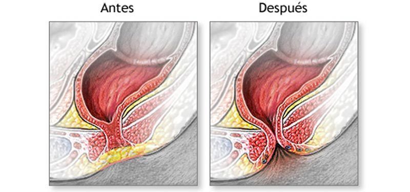ENFOQUE DEL PACIENTE Se debe realizar una inspección cuidadosa del periné para determinar la presencia o ausencia de una fistula. El médi...