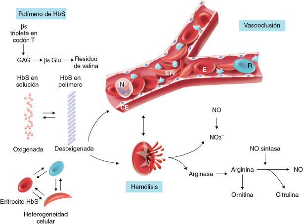 ANEMIA DE CÉLULAS FALCIFORMES