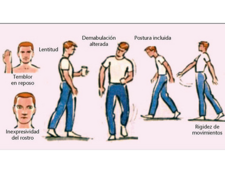 Aspectos nutricionales- enfermedad de Parkinson