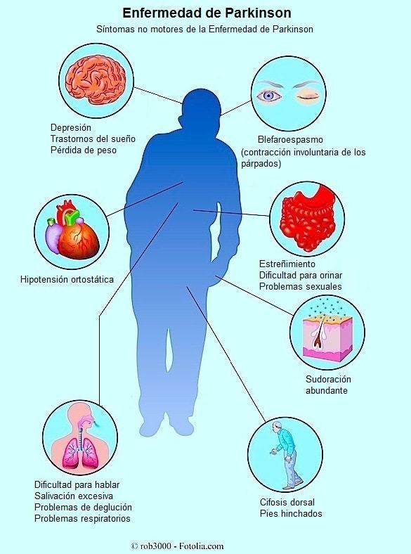 Aspectos nutricionales- enfermedad de Parkinson