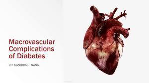 Sarcopenia: una complicación crónica en Diabetes mellitus tipo 2