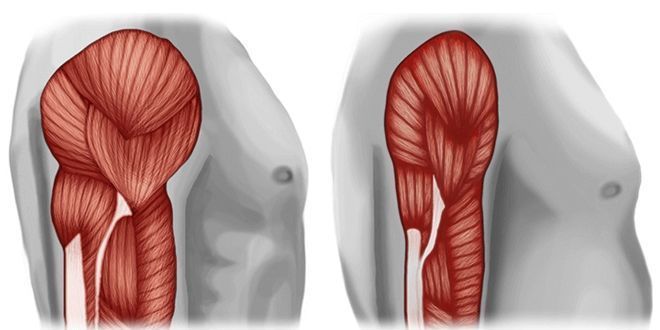 Sarcopenia: una complicación crónica en Diabetes mellitus tipo 2