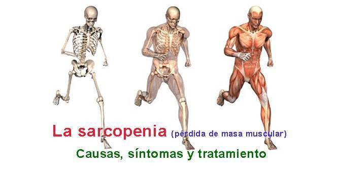 Sarcopenia: una complicación crónica en Diabetes mellitus tipo 2