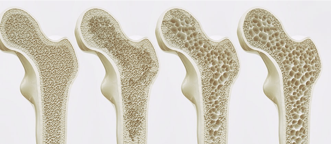 Sarcopenia: una complicación crónica en Diabetes mellitus tipo 2