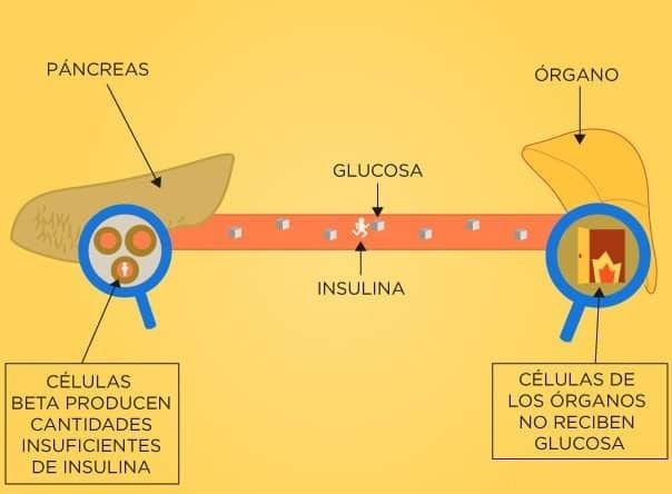 Sarcopenia: una complicación crónica en Diabetes mellitus tipo 2