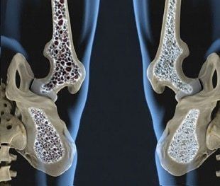 Sarcopenia: una complicación crónica en Diabetes mellitus tipo 2