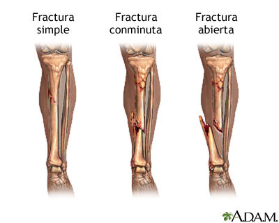 Sarcopenia: una complicación crónica en Diabetes mellitus tipo 2