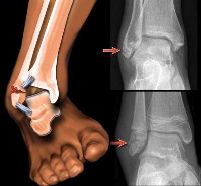 Sarcopenia: una complicación crónica en Diabetes mellitus tipo 2