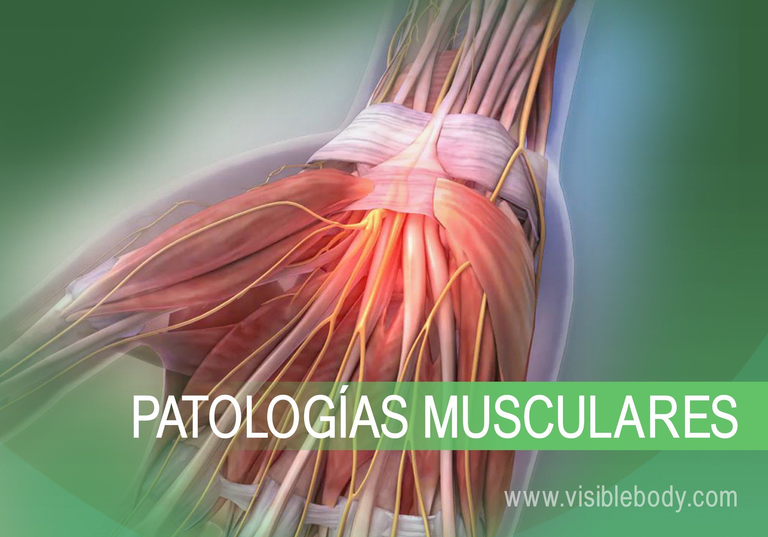 Sarcopenia: una complicación crónica en Diabetes mellitus tipo 2
