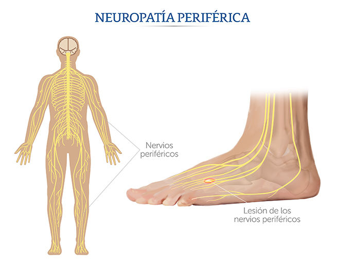 Sarcopenia: una complicación crónica en Diabetes mellitus tipo 2