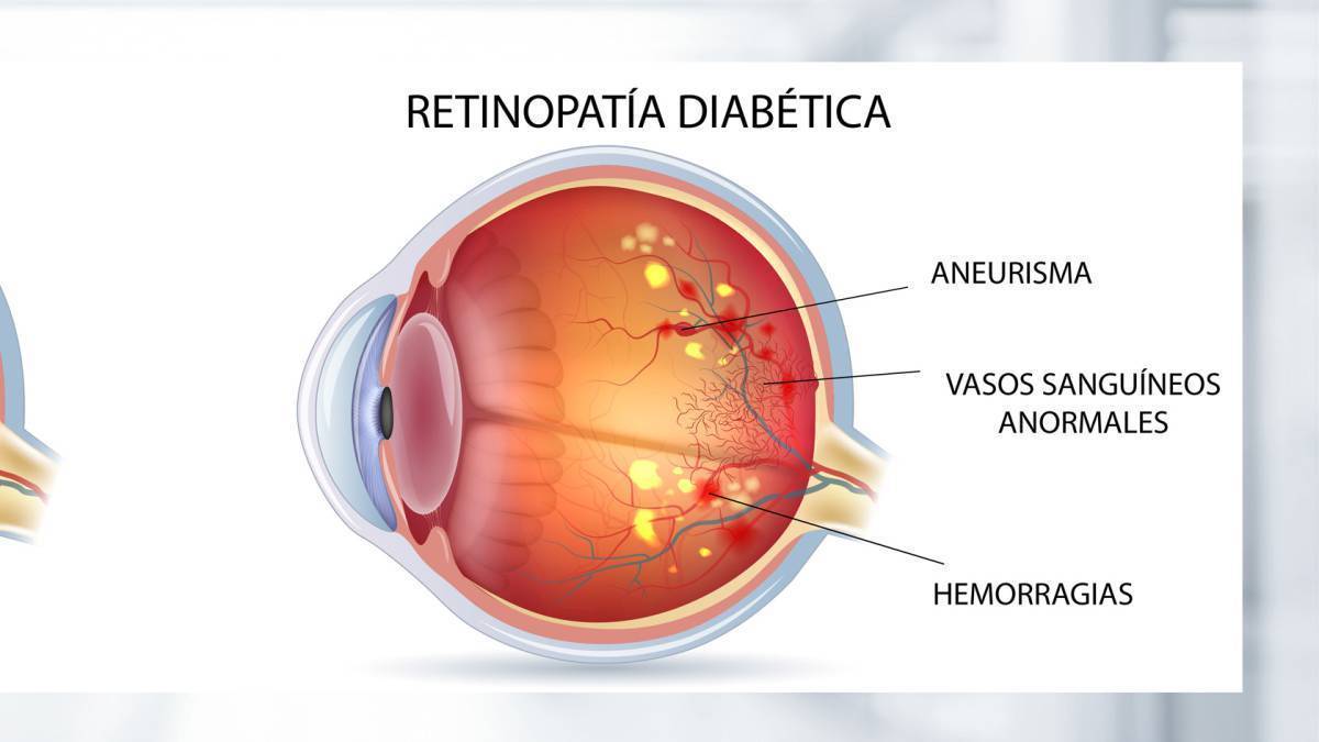 Sarcopenia: una complicación crónica en Diabetes mellitus tipo 2