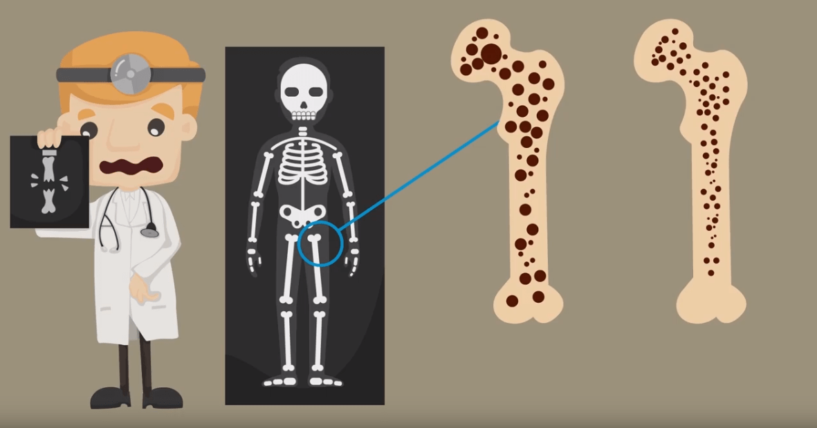Sarcopenia: una complicación crónica en Diabetes mellitus tipo 2