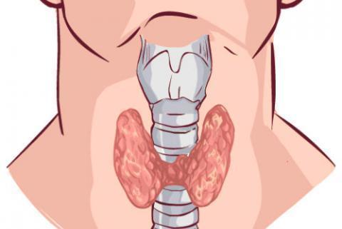 Sarcopenia: una complicación crónica en Diabetes mellitus tipo 2